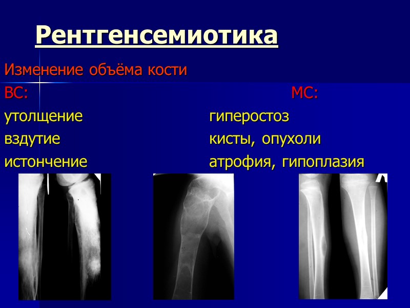 Рентгенсемиотика Изменение объёма кости  ВС:        